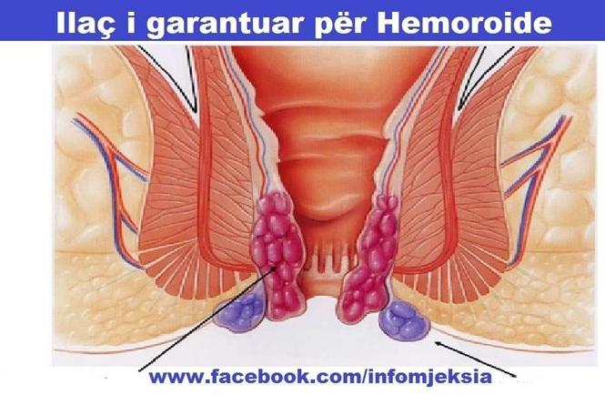 Mjaltë për Hemoroide
